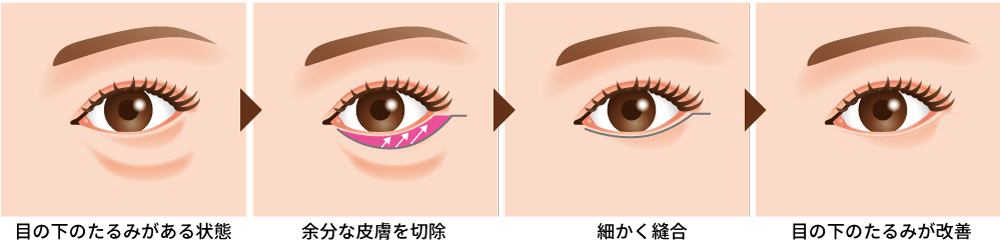 目の下のたるみ取り（切開法）の治療方法