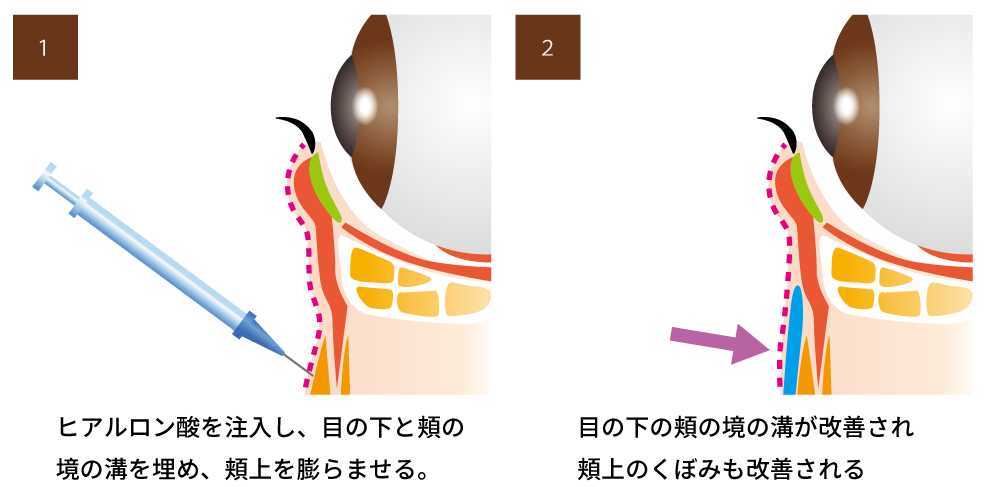 目の下のたるみ取り（ヒアルロン酸注入）の治療方法