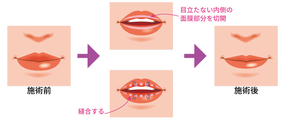 唇を薄くする治療方法