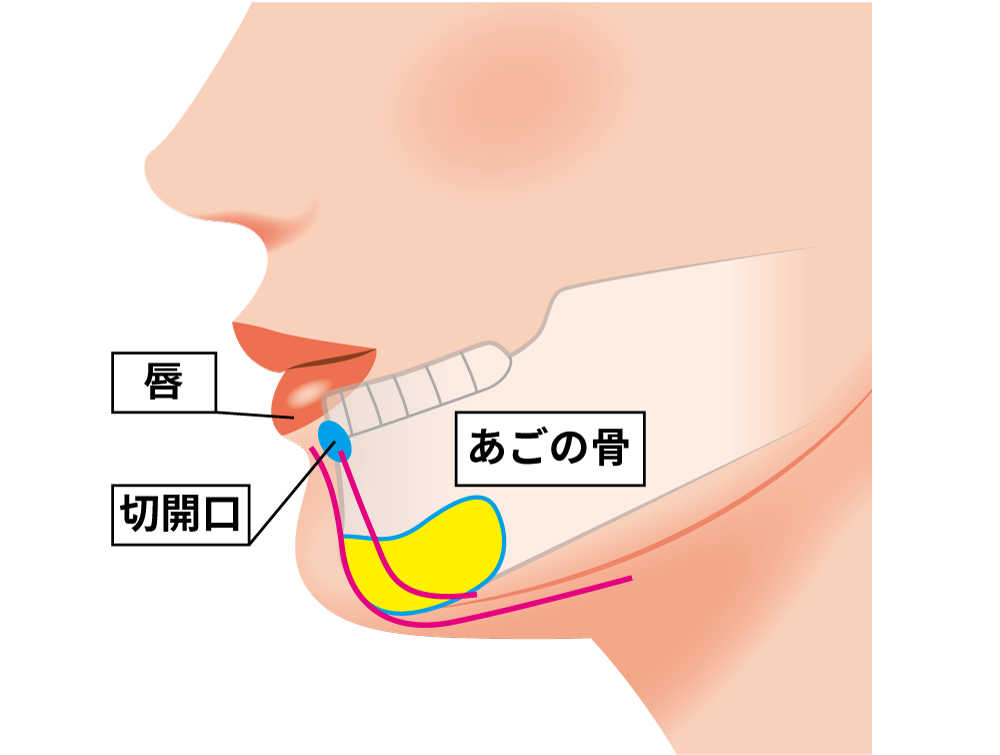 顎のプロテーゼ挿入