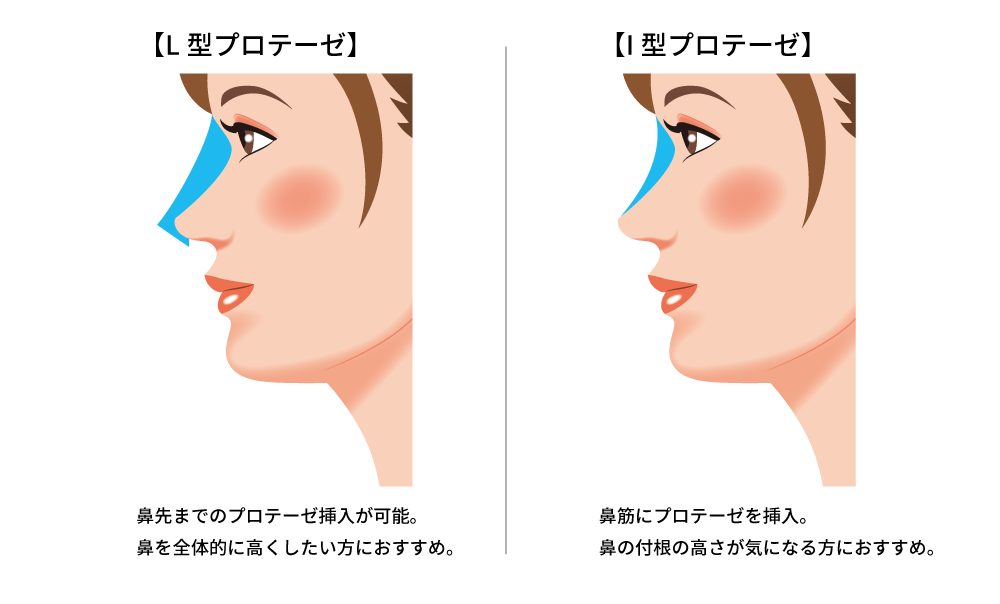 鼻プロテーゼの治療方法